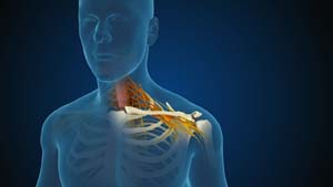 cervical-radiculopathy