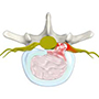 Lumbar Disc Herniation