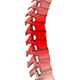 Spine Trauma